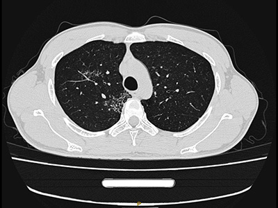 Imaging Analysis of 100 Cases of Pulmonary Nodules