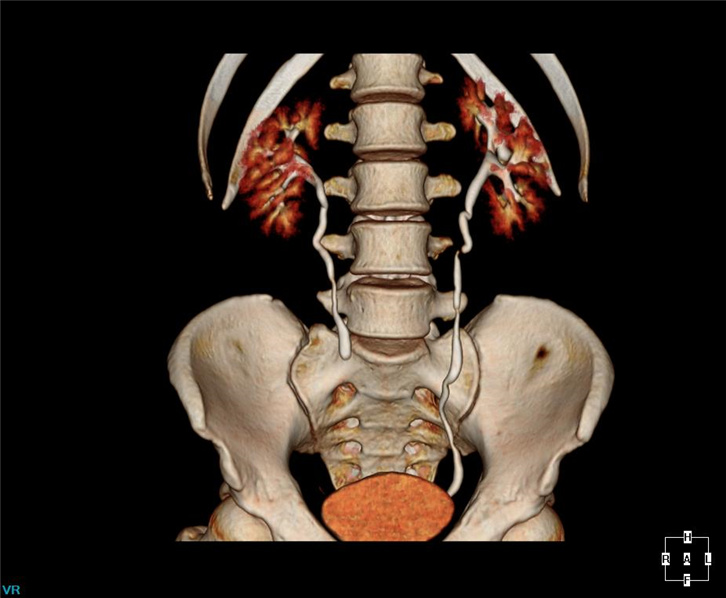 3D Urinary system