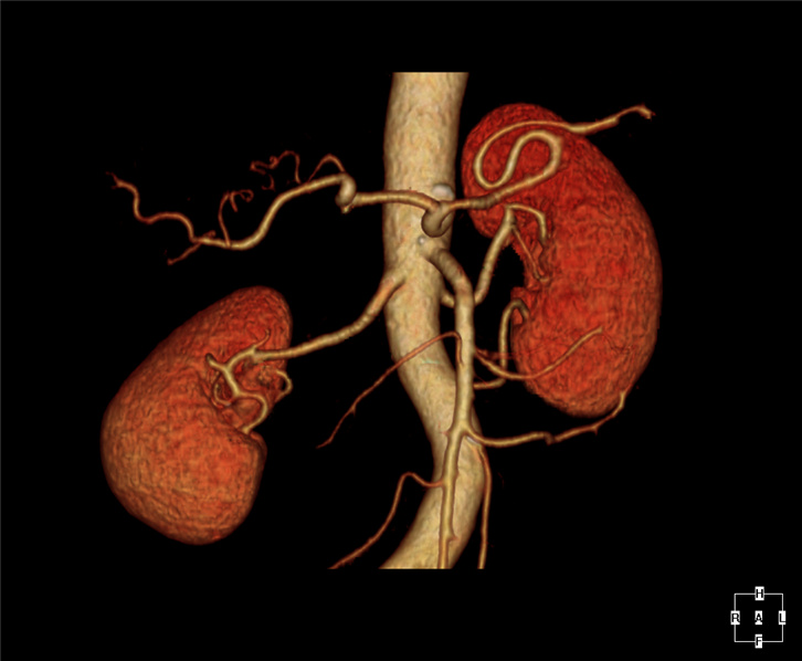 3D Abdomen CTA